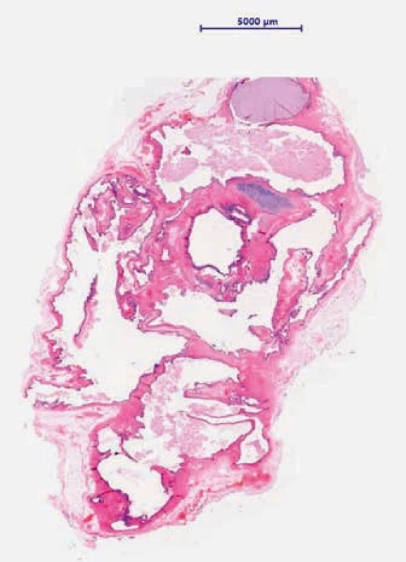 Tumor na řezu. Malé zvětšení; mnohotné cystické prostory; barvení hematoxylin-eosin (HE).