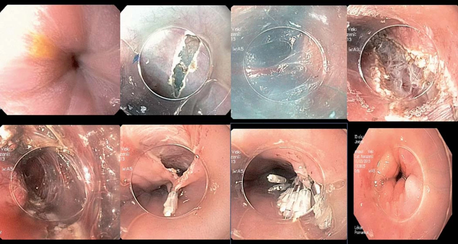 POEM – jednotlivá stadia perorální endoskopické myotomie.
Fig. 7. POEM – various stages of oral endoscopic myotonia.
