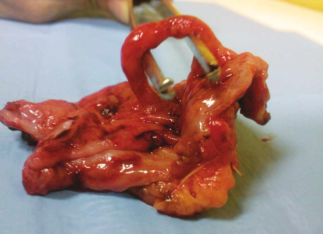Resekát ileotransversoanastomózy so slizničným mostíkom
Fig. 2. Resection of ileotransversoanastomosis with tissue bridge