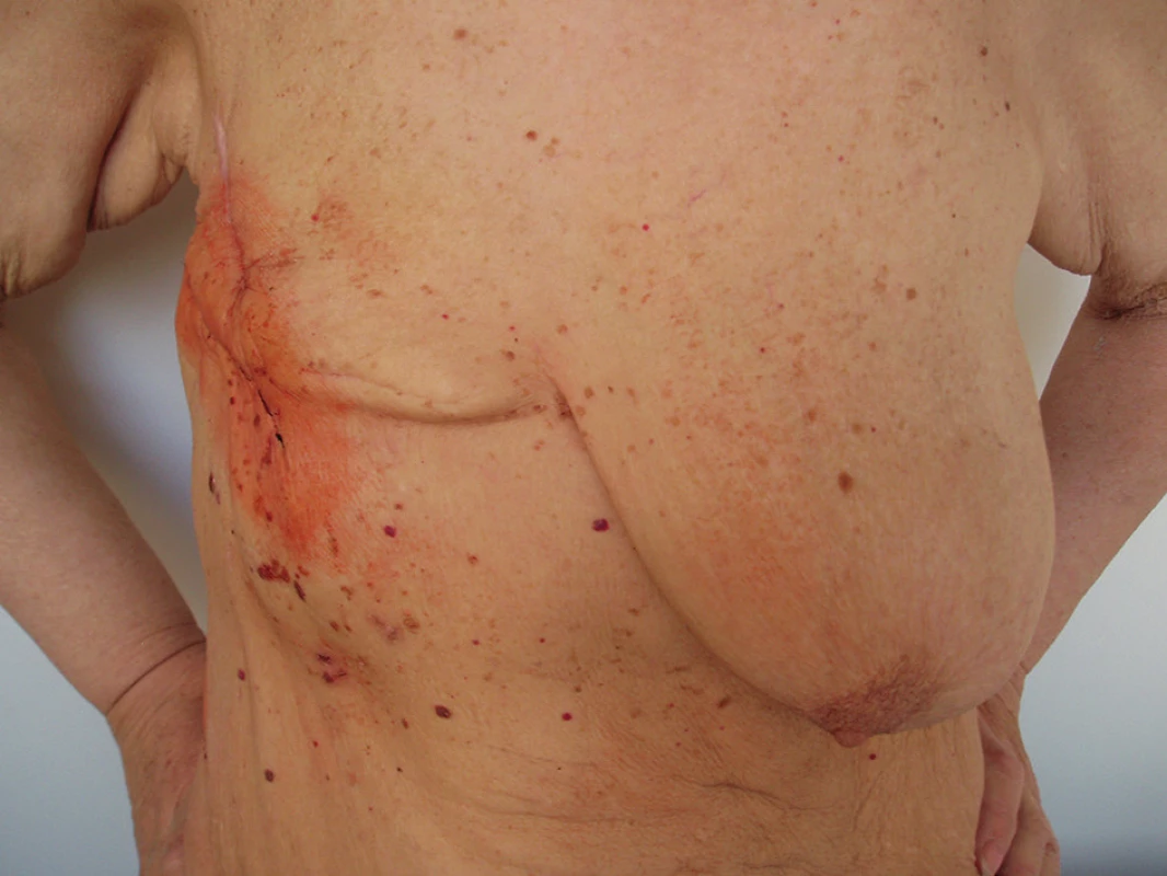 Výsledný efekt operace
Fig. 8: Final effect of the surgery