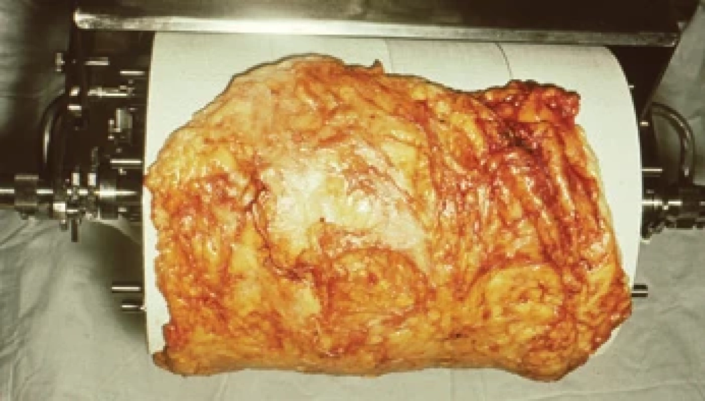Superdermatoma with removed tissue aff ected by elephantiasis.