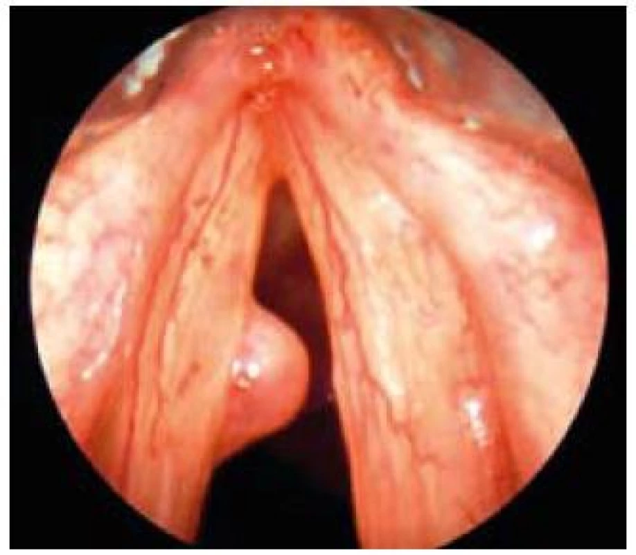 Polyp levé hlasivky.
Fig. 7. Polyp of the left vocal cord.