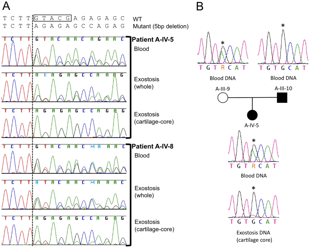 Loss of the wild-type <i>PTPN11</i> allele in the cartilage of two exostoses.