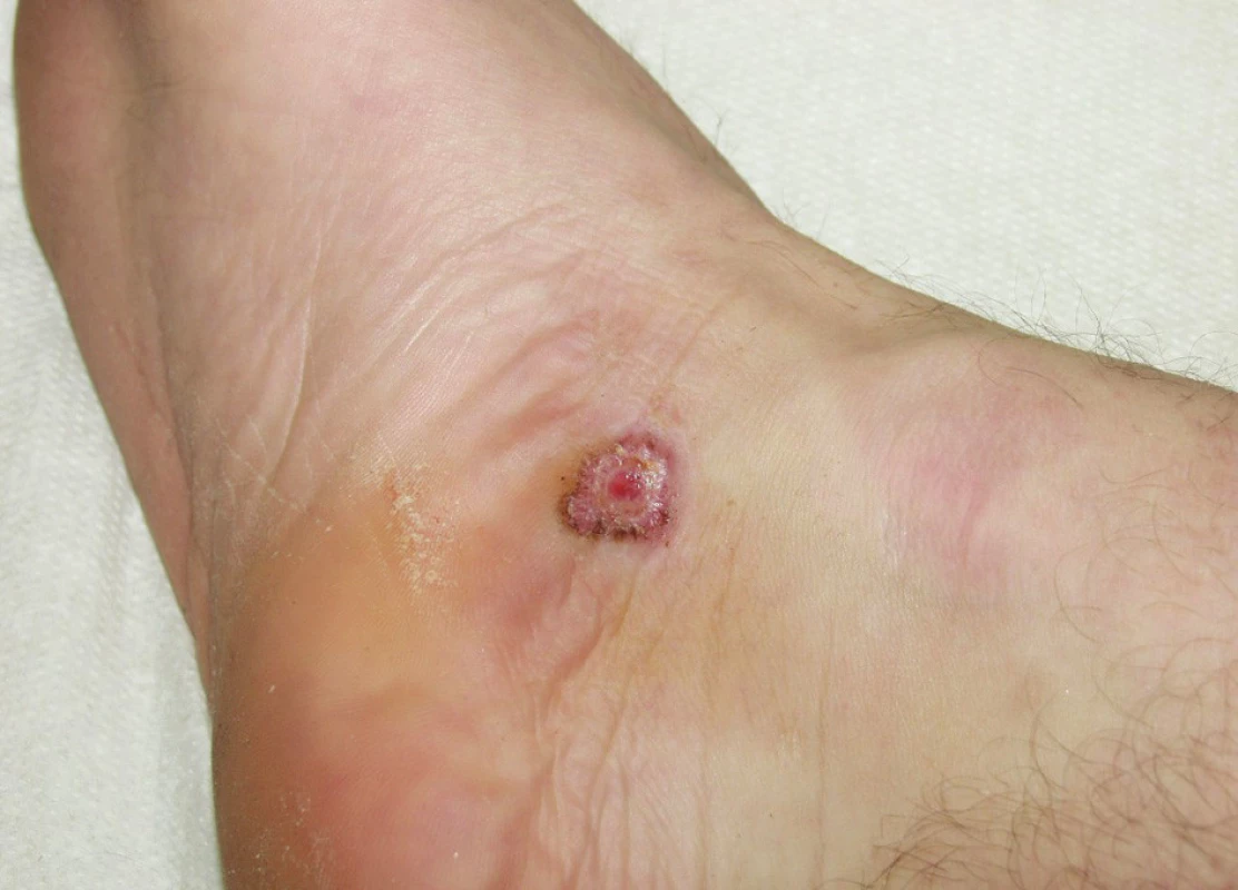 Maligní melanom při vnitřním kotníku dolní končetiny imitující vředovitý defekt (Foto z archivu Dermatovenerologické kliniky FN Plzeň)
Fig. 1: Malignant melanoma on the inner side of the ankle of the lower limb imitating chronic ulceration