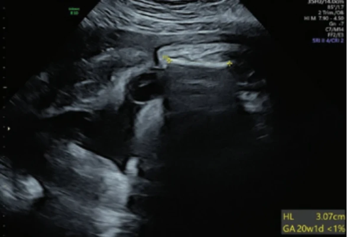 Fraktura pažní kosti – ultrazvukové vyšetření ve 37. gestačním týdnu. Fig. 1. Humerus fracture – ultrasound examination in 37th week of gestation.