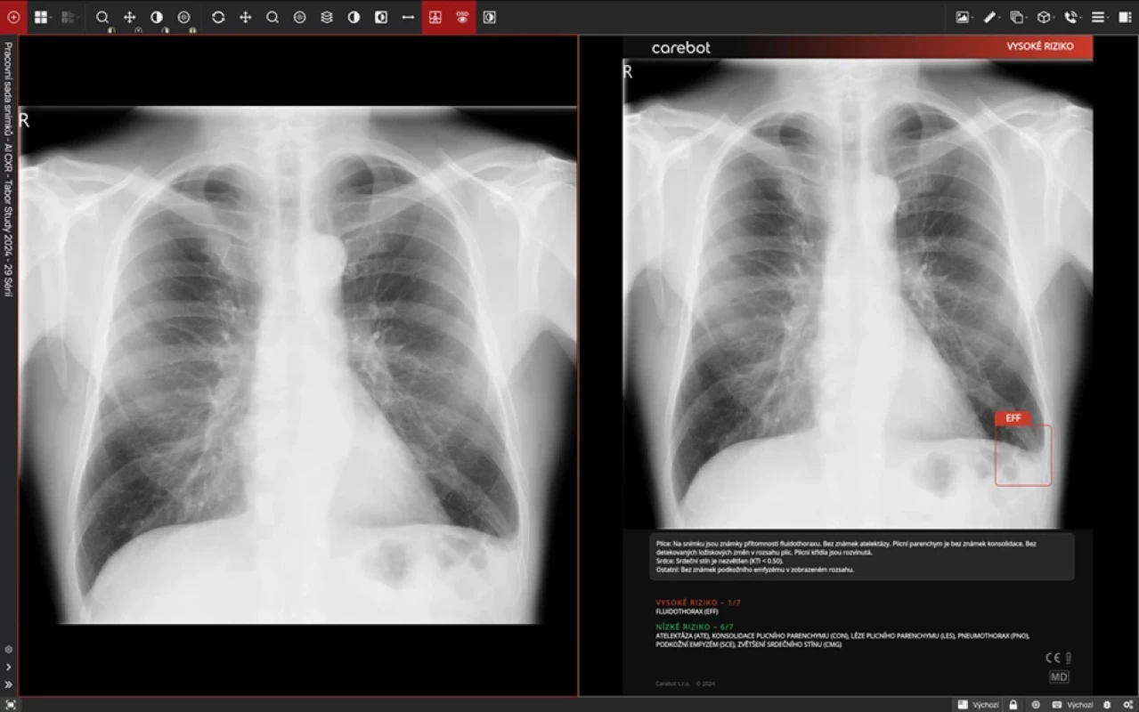 Původní rentgenový snímek hrudníku (vlevo) a jeho analýza provedená softwarem AI (vpravo, Carebot AI CXR). Software na upraveném snímku identifikoval a zvýraznil oblast s vysokým rizikem přítomnosti pleurálního výpotku (EFF).