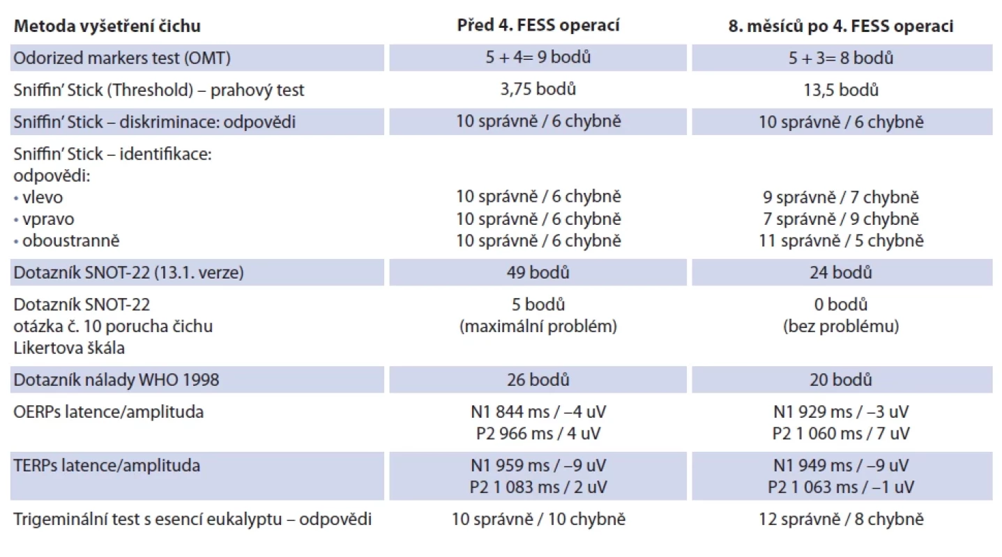 Kazuistika 1: srovnání výsledků čichových testů u subjektu s CRSwNP před/po chirurgické léčbě. Tab. 1. Case report 1: comparison of olfactory test results in a subject with CRSwNP before/after surgical treatment.