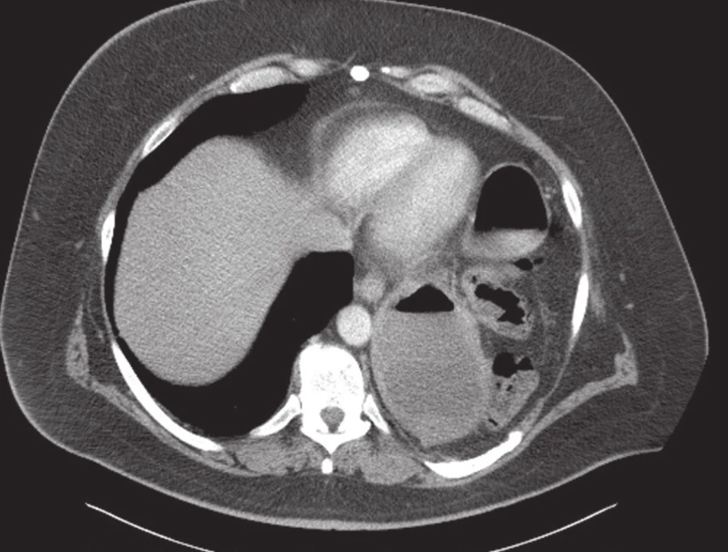 CT chronická ruptura levé poloviny bránice s útrobami v levé pleurální dutině
Fig. 5: CT finding of chronic left-sided diaphragmatic rupture; viscera in the left pleural cavity
