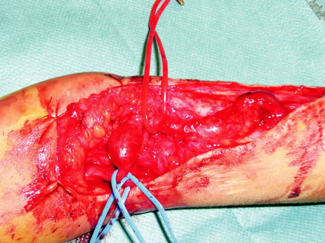 Peroperačný nález brachiocefalickej fistuly
Fig. 4. Intraoperative finding of a brachiocephalic fistula