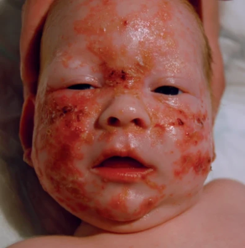 Acrodermatitis enteropathica