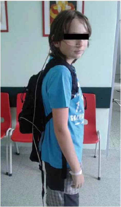 Pacient se zavedenou sondou. V batůžku má enterální pumpu a vak enterální výživy.
Fig. 1. Patient with tube feeding. Enteral pump and bag are in the backpack.