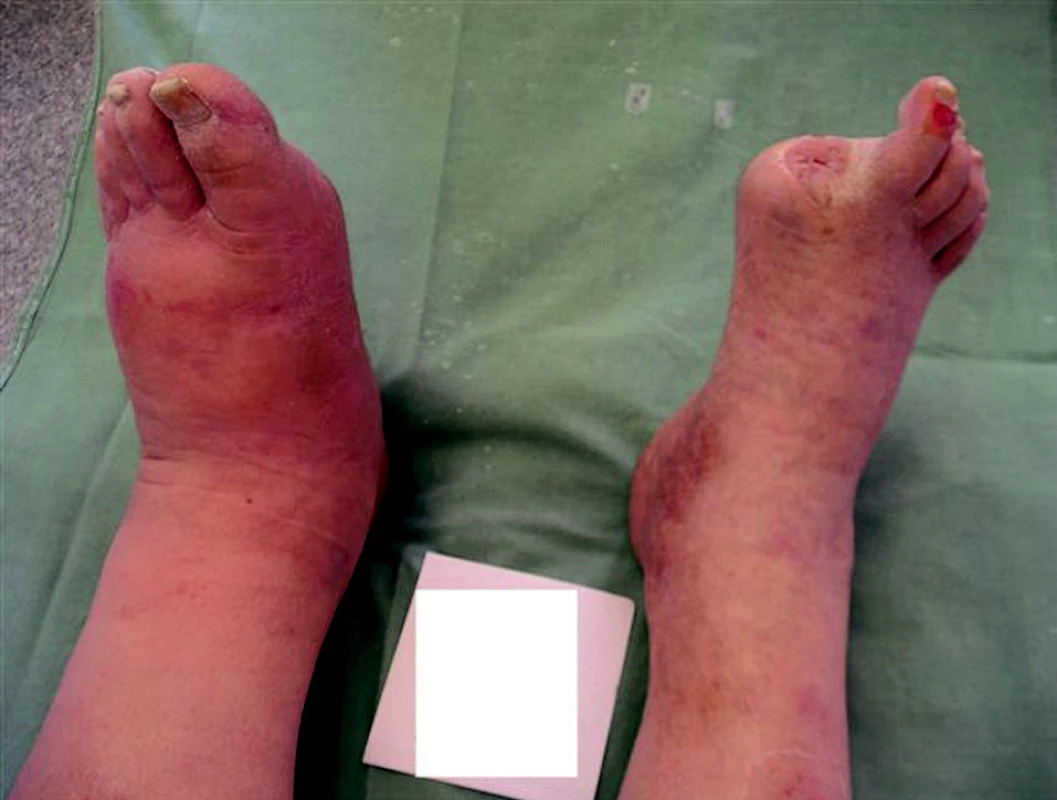 Akutní Charcotova osteoartropatie.