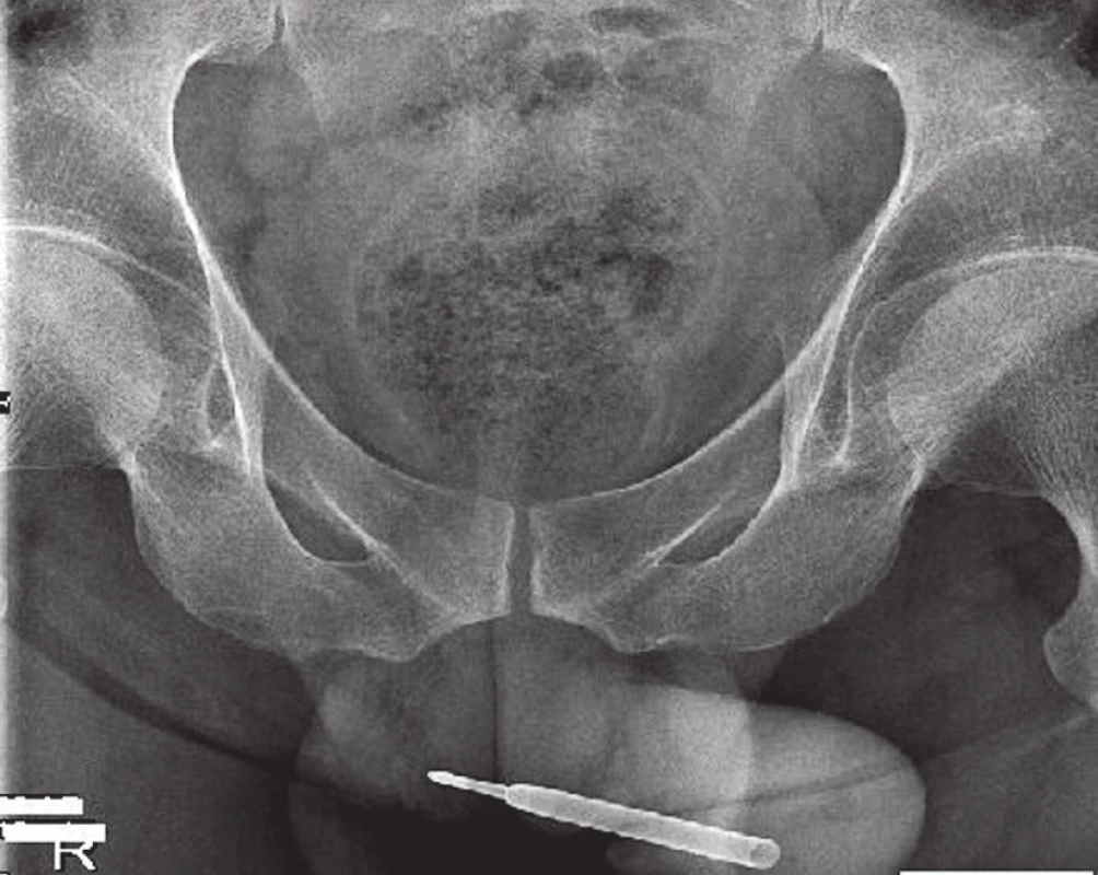 Náplň propisovací tužky v penilní uretře
Fig. 1. Plain fi lm cystography, pen cartridge in the penile urethra