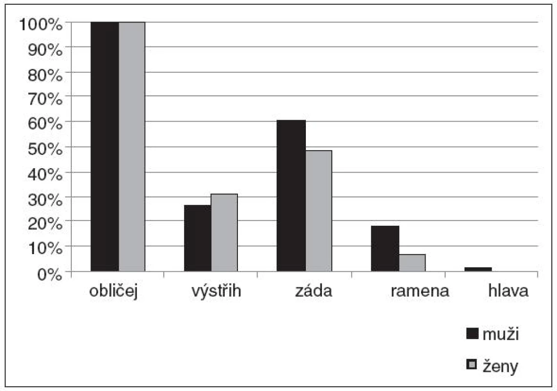 Lokalizace akné.