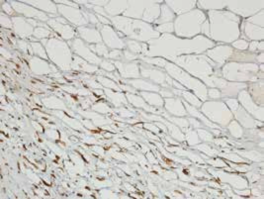 Mierna aktivácia myofibroblastov
vo fibrotických oblastiach – IHC farbenie