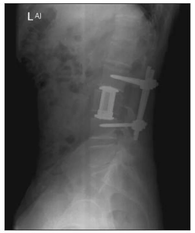 Skiagram lumbosakrální páteře, bočný. Pooperační stav po kombinované stabilizaci obratle L3
Fig. 4. Plain x-ray, lumbosacral spine, lateral view. Postoperative examination following combined L3 stabilization
