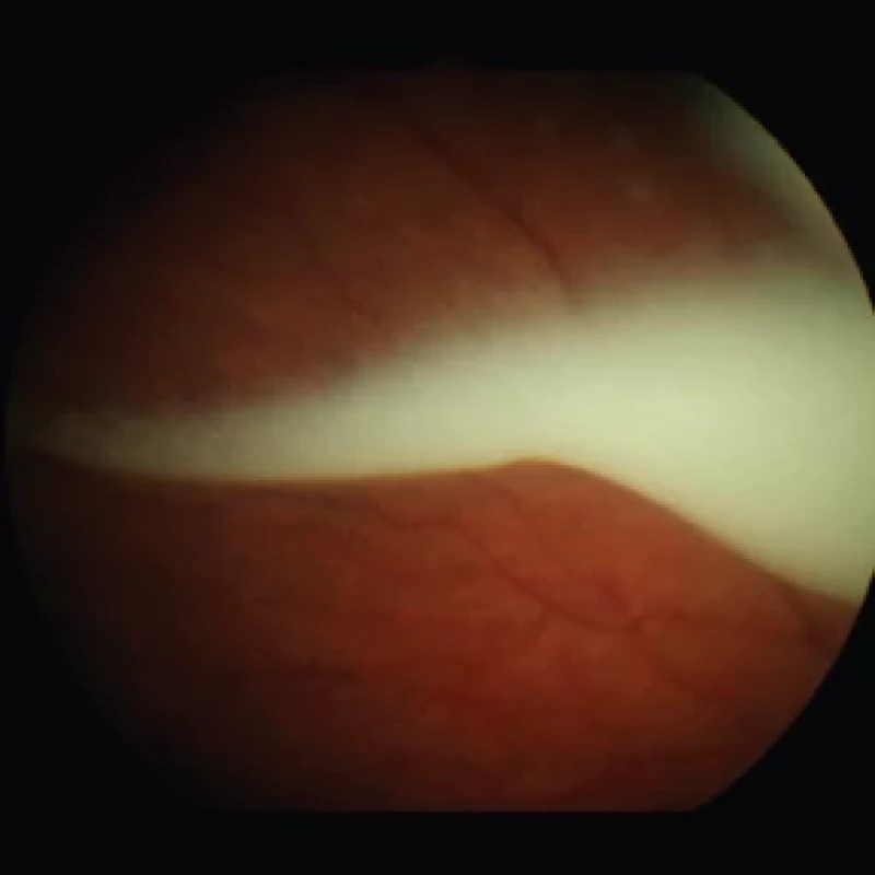 Classification of vitreous seeds: clouds