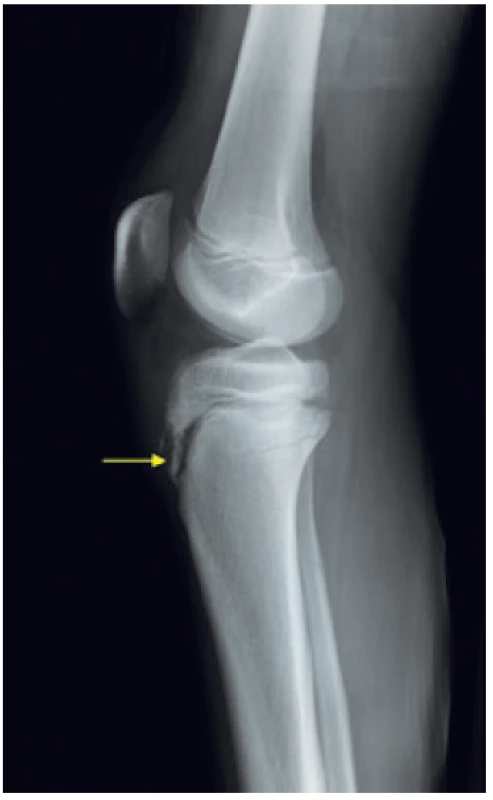 RTG zobrazení M. Osgood–Schlatter (7).