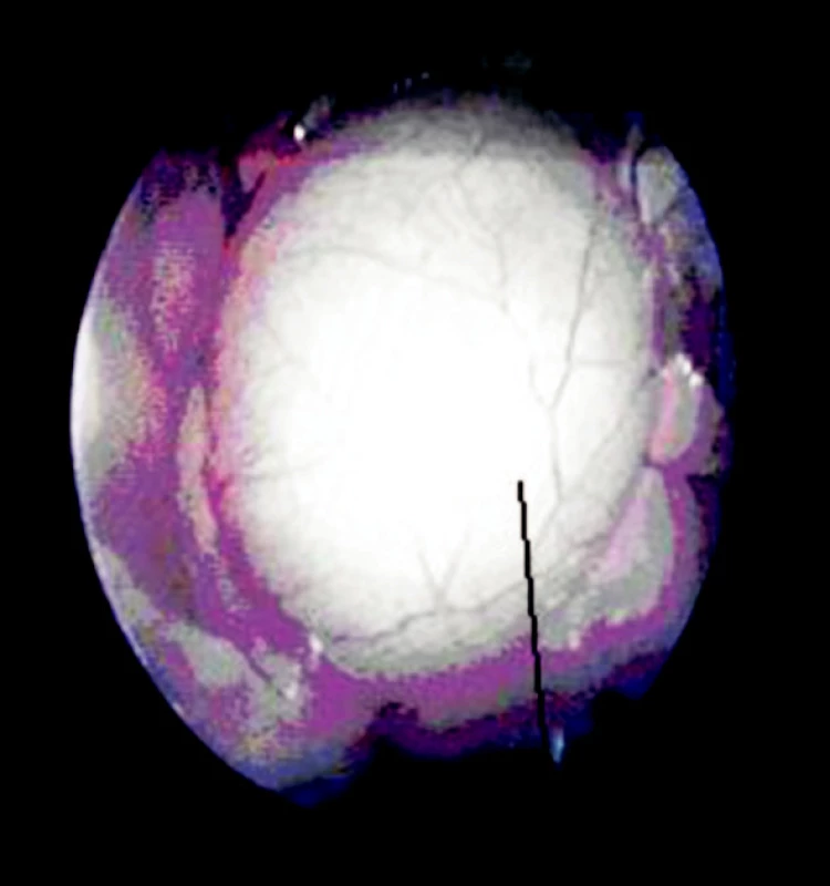 VTS pohled na parakardiální cystu
Fig. 11 VTS view of the paracardial cyst