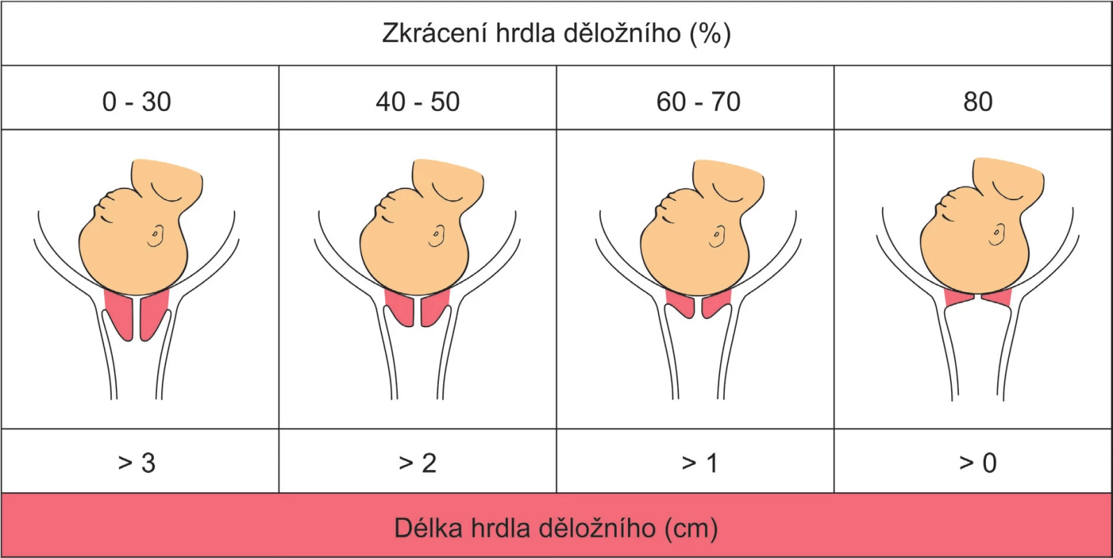 Hodnocení ZKRÁCENÍ/DÉLKY hrdla děložního