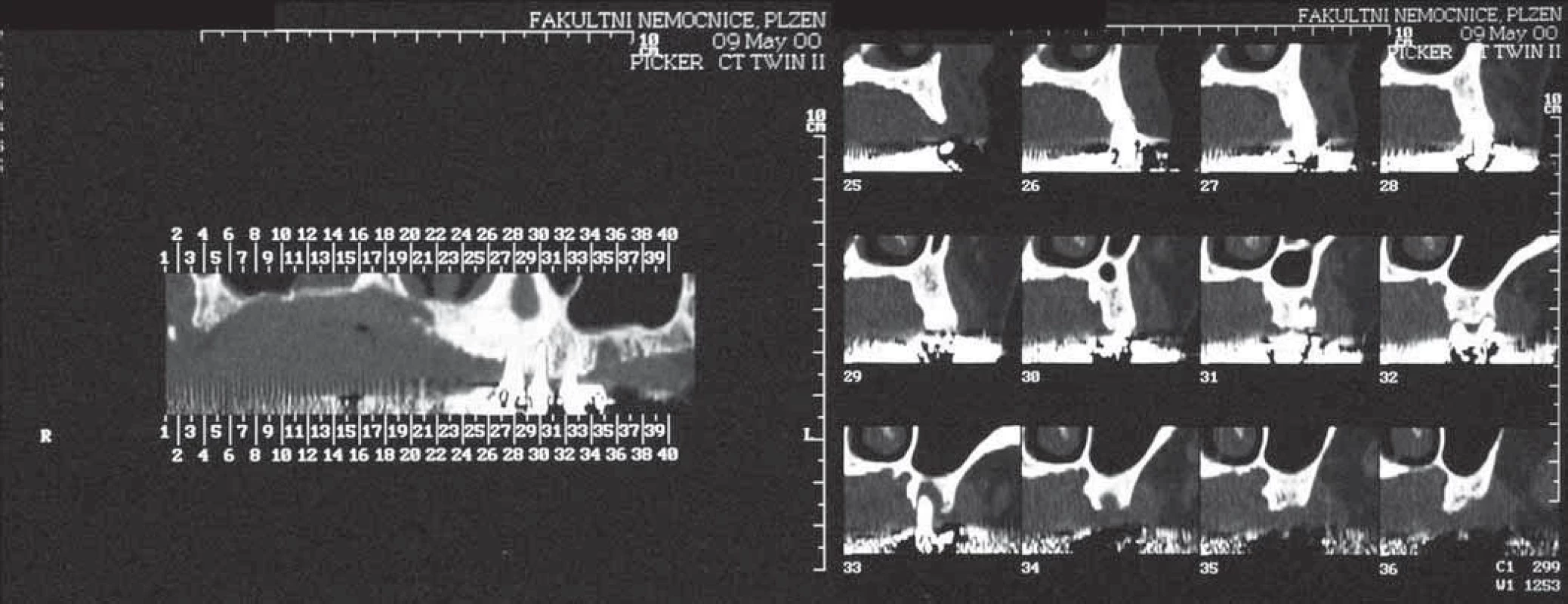 The past. Plain fi lm analysis. Neither adjustments of the picture nor any other tools like distance measurement were possible.