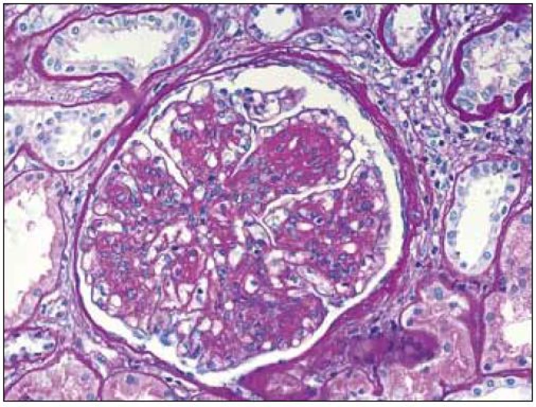 Glomerulus s mezangiální proliferací, se zmnožením mezangiální matrix a nodulárními formacemi při LCDD. Ztluštělé tubulární bazální membrány. Barvení PAS, objektiv 40krát.
