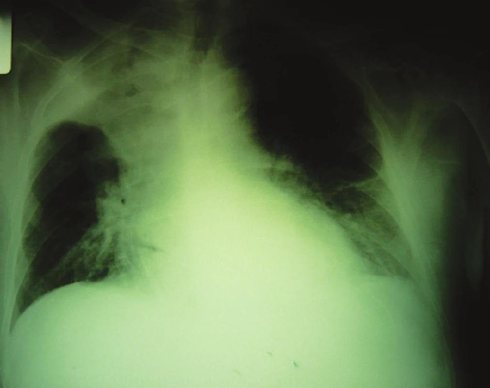 RTG nález tumoróznej masy v pravom hornom pľúcnom poli
Fig. 5. RTG finding of a tumorous mass in the right upper lung region