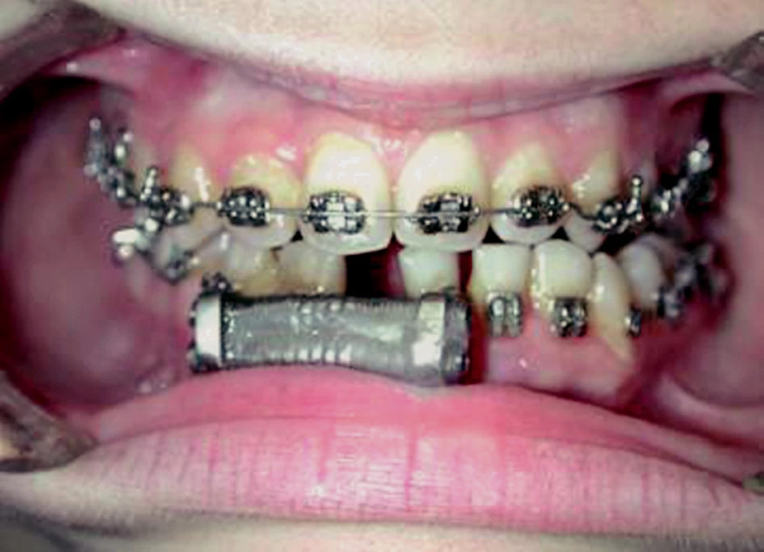 Trans Mandibular Distractor (TMD), a bone-borne distractor for widening the narrow mandible