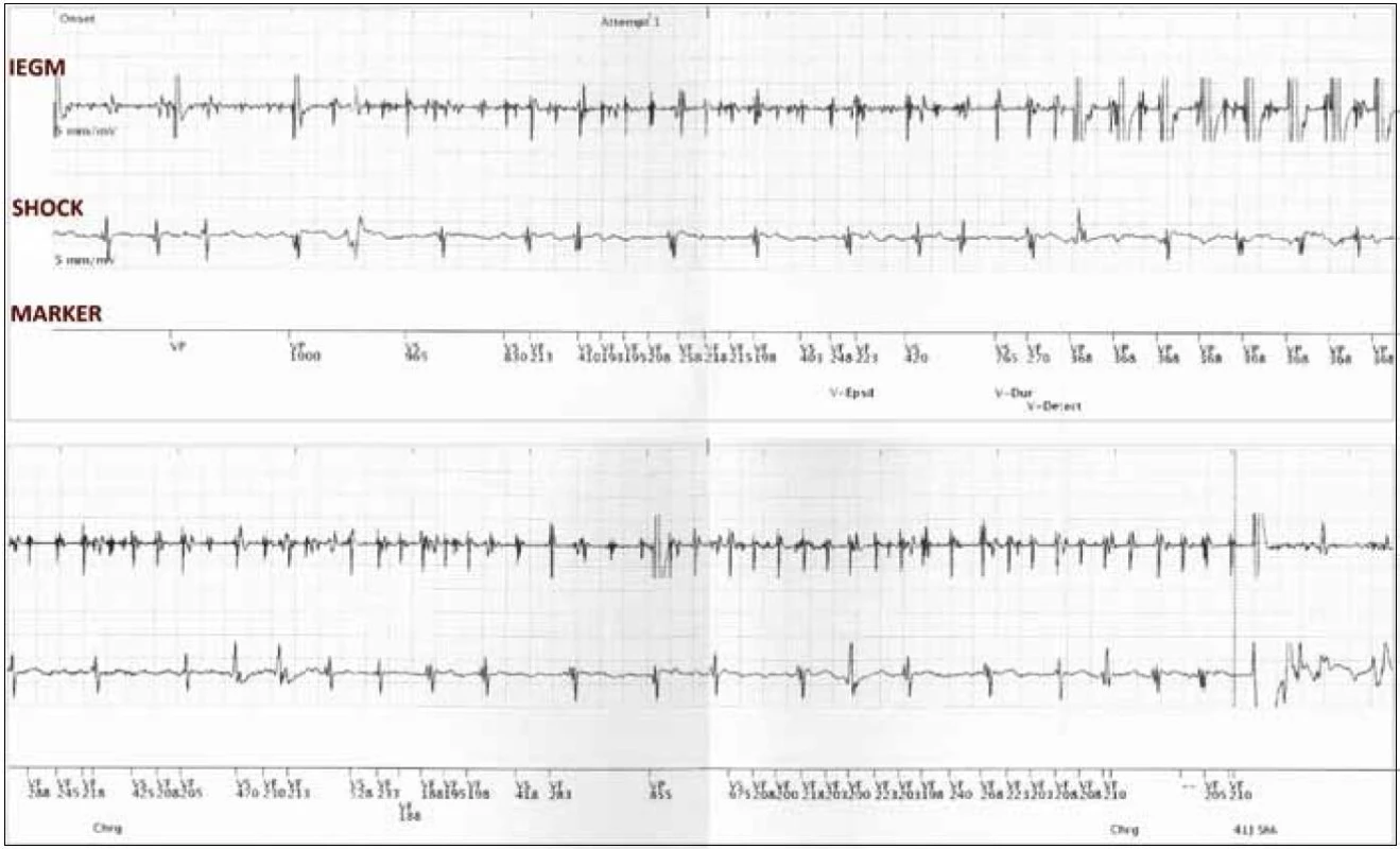 Záznam události v zóně VF v paměti ICD: na intrakardiálním elektrogramu patrna porucha sensingu – undersensing R vln a současně intermitentní vnímání fibrilačních vln z pravé síně s falešnou detekcí komorové fibrilace řešené antitachykardickou stimulací a následným výbojem ICD. IEGM – intrakardiální elektrogram vnímaný defibrilační elektrodou, SHOCK – far-field IEGM – signál mezi cívkou defibrilační elektrody a pouzdrem ICD, MARKER – markerový kanál zobrazující interpretaci IEGM implantabilním defibrilátorem (VS – vnímání vlastní fyziologické komorové aktivity, VF – vlastní aktivita v zóně komorové fibrilace, VP – komorová stimulace).