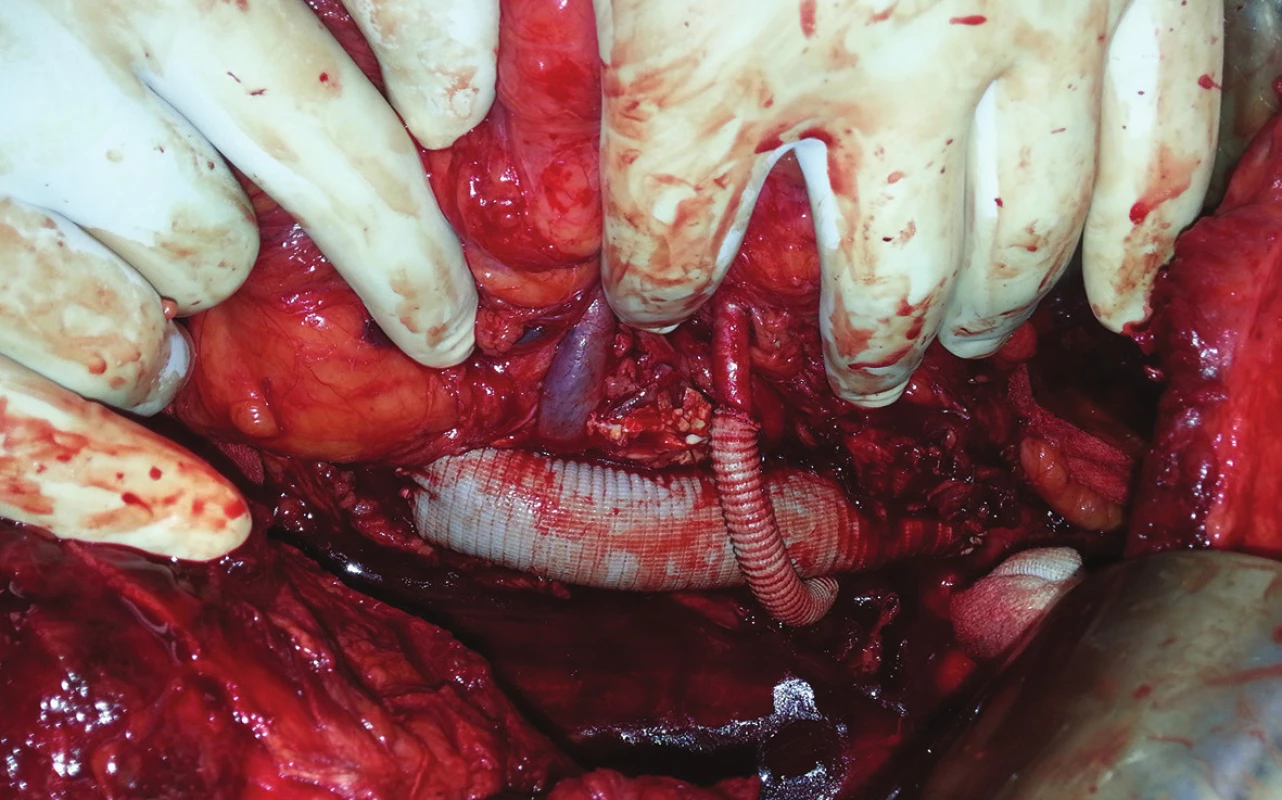 Náhrada aorty s byppasem na pravou i levou renální tepnu
Fig. 7: Aortic replacement with bypass to right and left renal artery