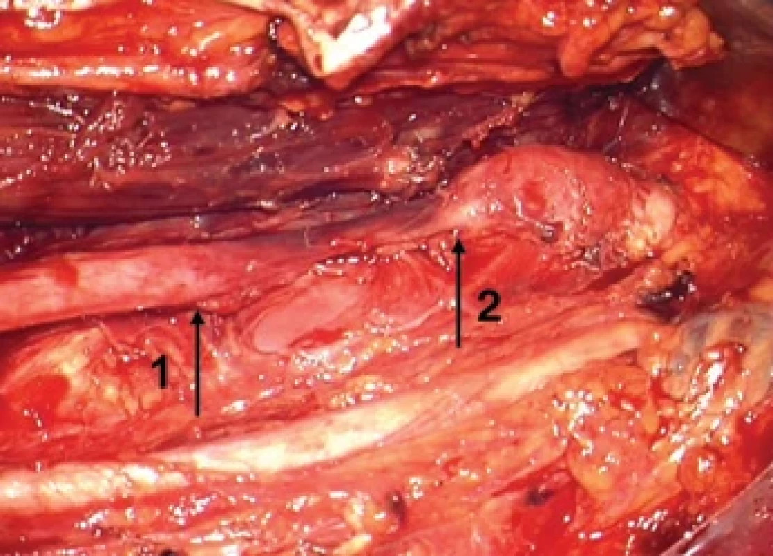 Preoperative situation showing the neuroma-in-continuity (between arrows, 6 cm long).