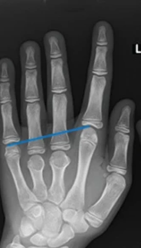 Illustrative preoperative radiograph showing brachymetacarpia of both the third and fourth metacarpals, with positive Archibald’s sign (blue line indicates misalignment of the metacarpal heads).