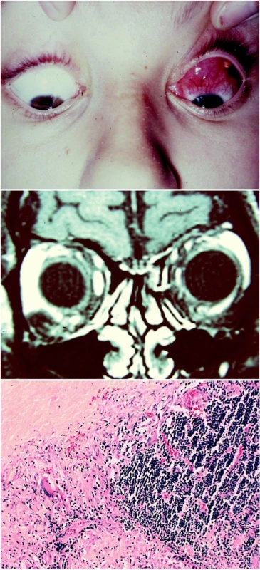 a. Nodulární tumor pod spojivkou vlevo
b. MR: plášťovité zduření pod stropem levé očnice
c. Histologie: Lipogranulom orbity, parafin. řez, barvení Gi- Obr. 2c. Normalizace polohy oka po kortikosteroidní terapii emsa, zvětšení 125krát