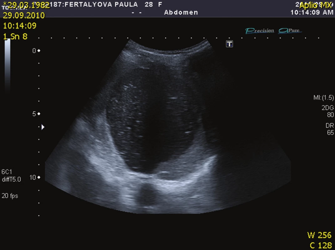 USG nález cysty před výkonem (kazuistika 1)
Fig. 1: US finding of a cyst, prior to the procedure (case 1)