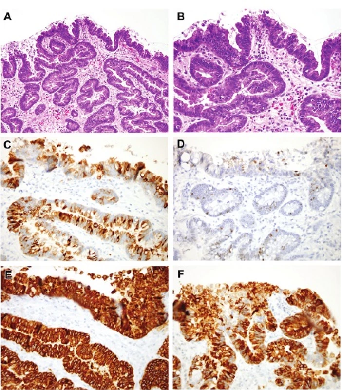 A. Dysplasia with mixed differentiation. This tangentially embedded biopsy shows high-grade dysplasia with a host of types of differentiation. At this magnification there is a suggestion of goblet cells as well as of foveolar cells. Angulated glands are not a necessarily a sign of invasion in this tangential example. H&amp;E (100x). B. It is easy to detect loss of nuclear polarity in this example of high-grade dysplasia. H&amp;E (200x). C. This is a MUC2 (same lesion as that seen in Figures 6A and 6B) highlighting abundant goblet cells. MUC2 (200x). D. This is a CDX2 (same lesion as that seen in Figures 6A and 6B) showing occasional immunoreactive nuclei. CDX2 (200x). E. This is a MUC5 that highlights foveolar mucin (same lesion as that seen in Figures 6A and 6B). MUC5AC (200x). F. This is a MUC6 that highlights pyloric gland mucin (same lesion as that seen in Figures 6A and 6B). MUC6 (200x).