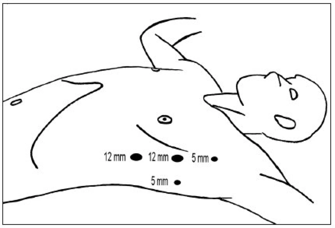 Rozmístění portů při torakoskopické tymektomii v přední a zadní axilární linii
Fig. 2. Thoracoscopic thymectomy port site positions in anterior and posterior axillary line