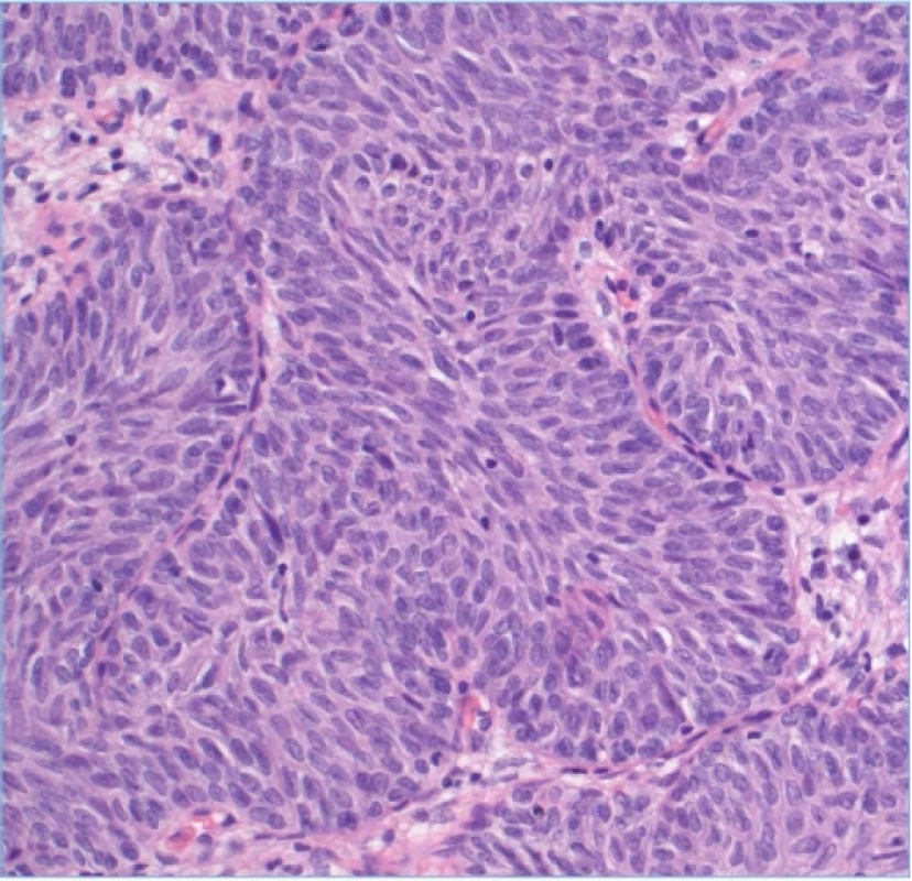 Histologie IUP se zvětšením (hematoxylin-eozin). Fig. 5. Histology of IUP with magnification 