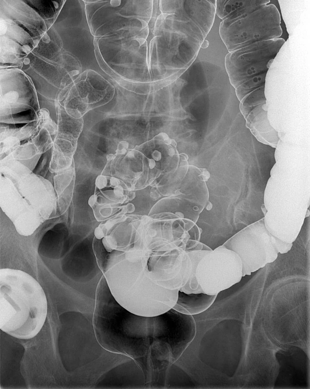 Irrigografické vyšetření: divertikulární choroba tračníku