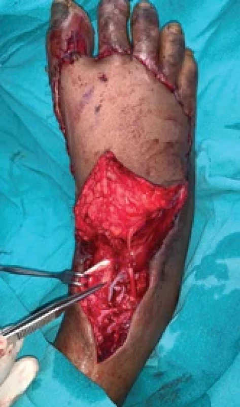 Anterolateral thigh fl ap after the second vein anastomosis.