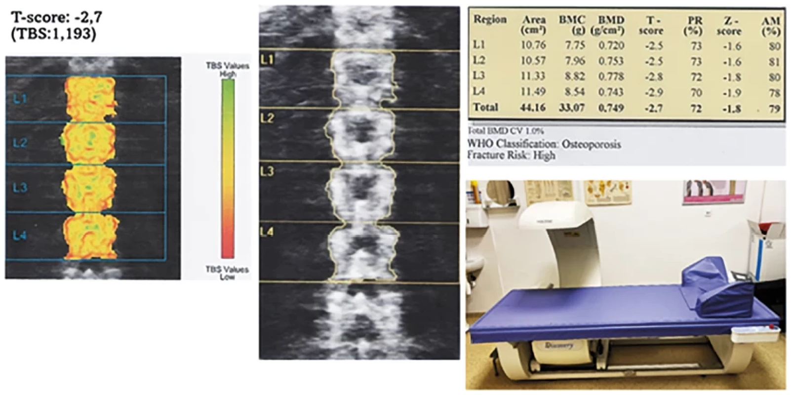 Results of densitometric examination in an osteoporotic patient 53 years old: BMD = 0.749; T-score = -2.7; TBS = 1,193 (own processing – Osteo centrum AGEL Hospital in Košice-Šaca)