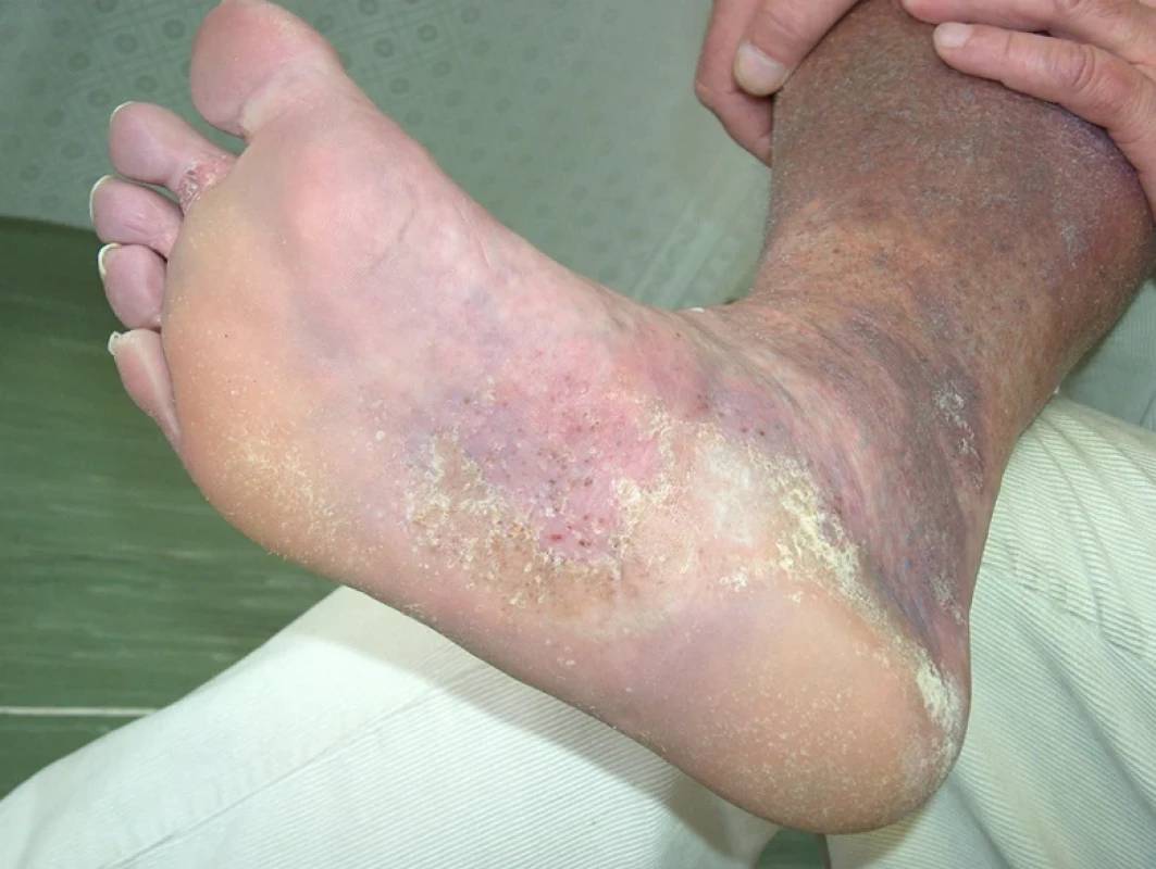 Tinea pedum – vezikuly, deskvamace