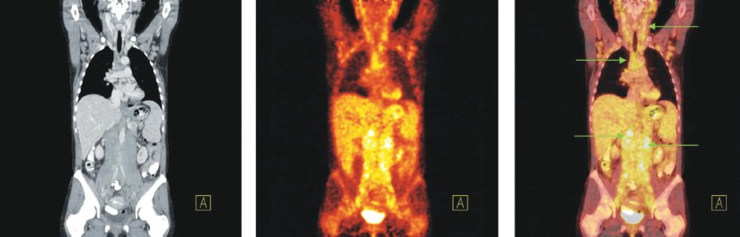 Snímky výpočetní tomografie (CT), pozitronové emisní tomografie (PET) a PET/CT u nemocné s nově zjištěnou diagnózou chronické B-lymfocytární leukemie a genetickou abnormalitou 17p-. Zvýšená akumulace 18F-FDG ve splývajících lymfatických uzlinách na krku, v lymfatických uzlinách supra- i infraklavikulárně, v obou axilách, ve všech oddílech mediastina, v rozsáhlé měkkotkáňové mase sahající od jater a sleziny až ke dnu malé pánve, ve které jsou zavzaty všechny cévní svazky, aorta i dolní dutá žíla a také v lymfatických uzlinách obou třísel, které nejsou na zobrazených řezech patrné.