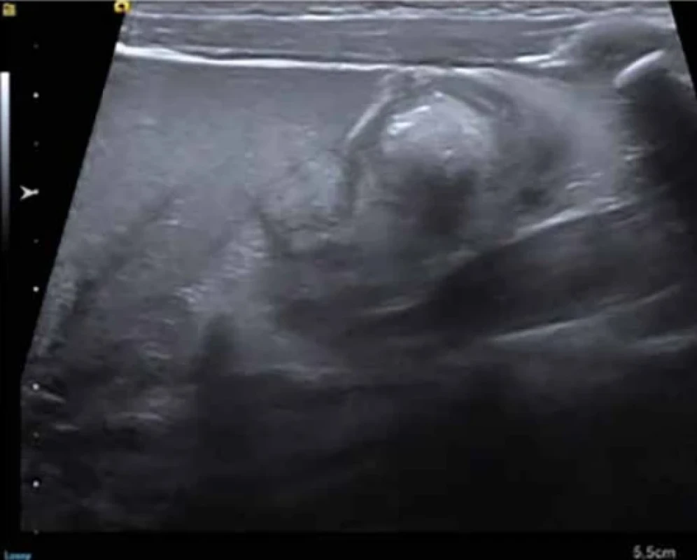 Ultrasonografický obraz hyperechogénnych más v tenkom čreve [9]