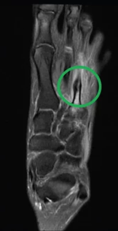 Únavová zlomenina III. metatarzu zobrazena pomocí magnetické rezonance (archiv autora).<!br> Fig. 4. Fatigue fracture of the third metatarsal shown by magnetic resonance imaging (author‘s archive).