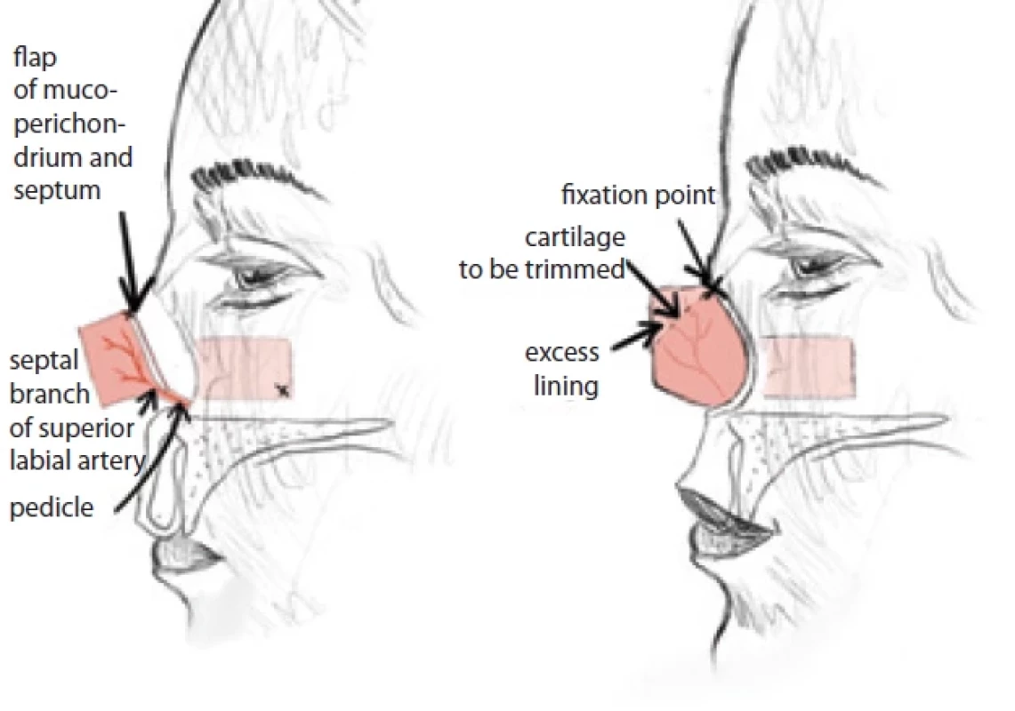 Composite septal fl ap. (Drawing by A. Berkeš according to [2]).