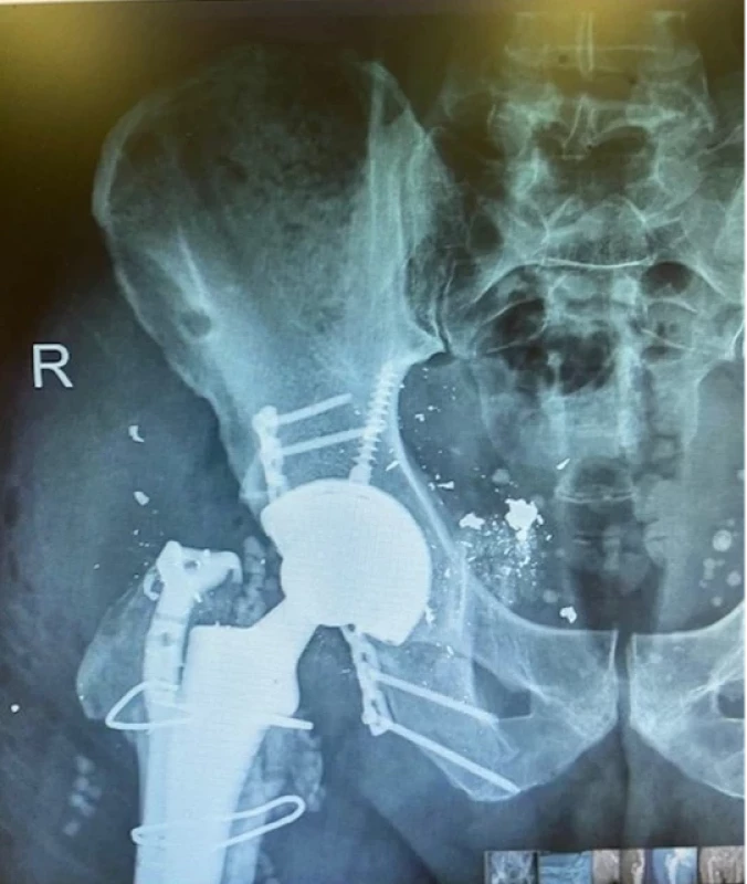 Stav po implantaci totální endoprotézy kyčelního kloubu v Singapuru