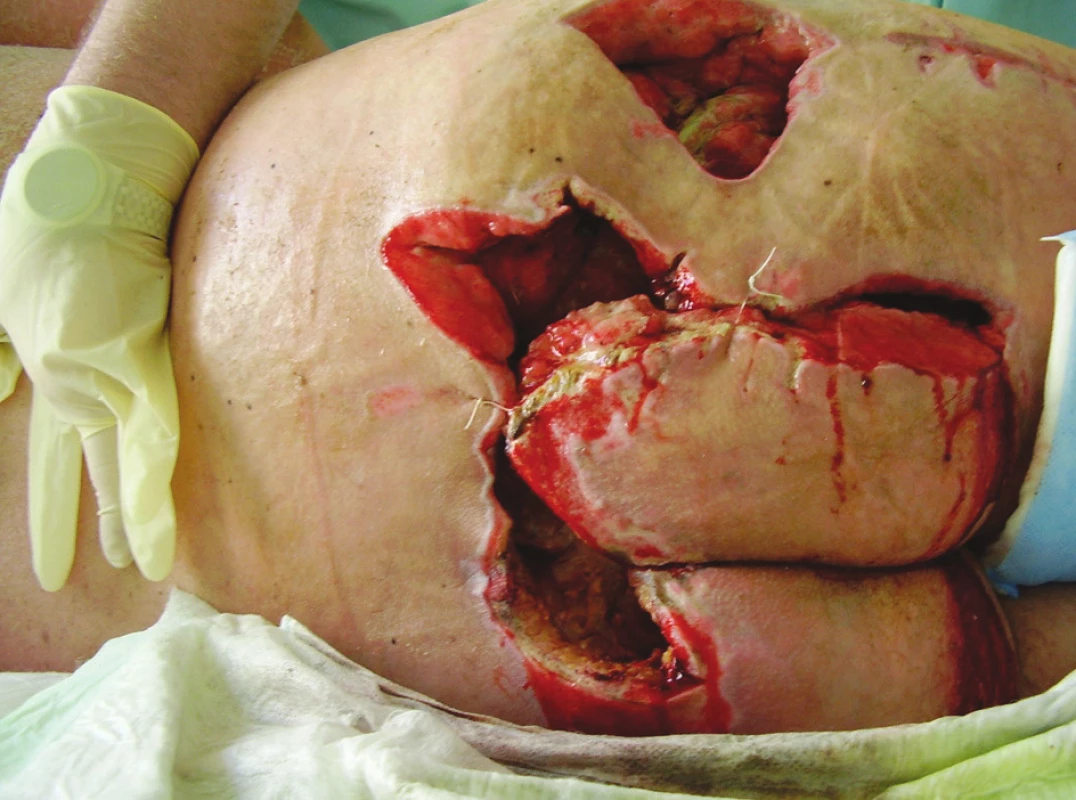 Defekty v oblasti gluteální krajiny a kyčelní krajiny vpravo po prvotních nekrektomiích
Fig. 4. Defects of the gluteal, sacral and right hip area after primary necrectomies