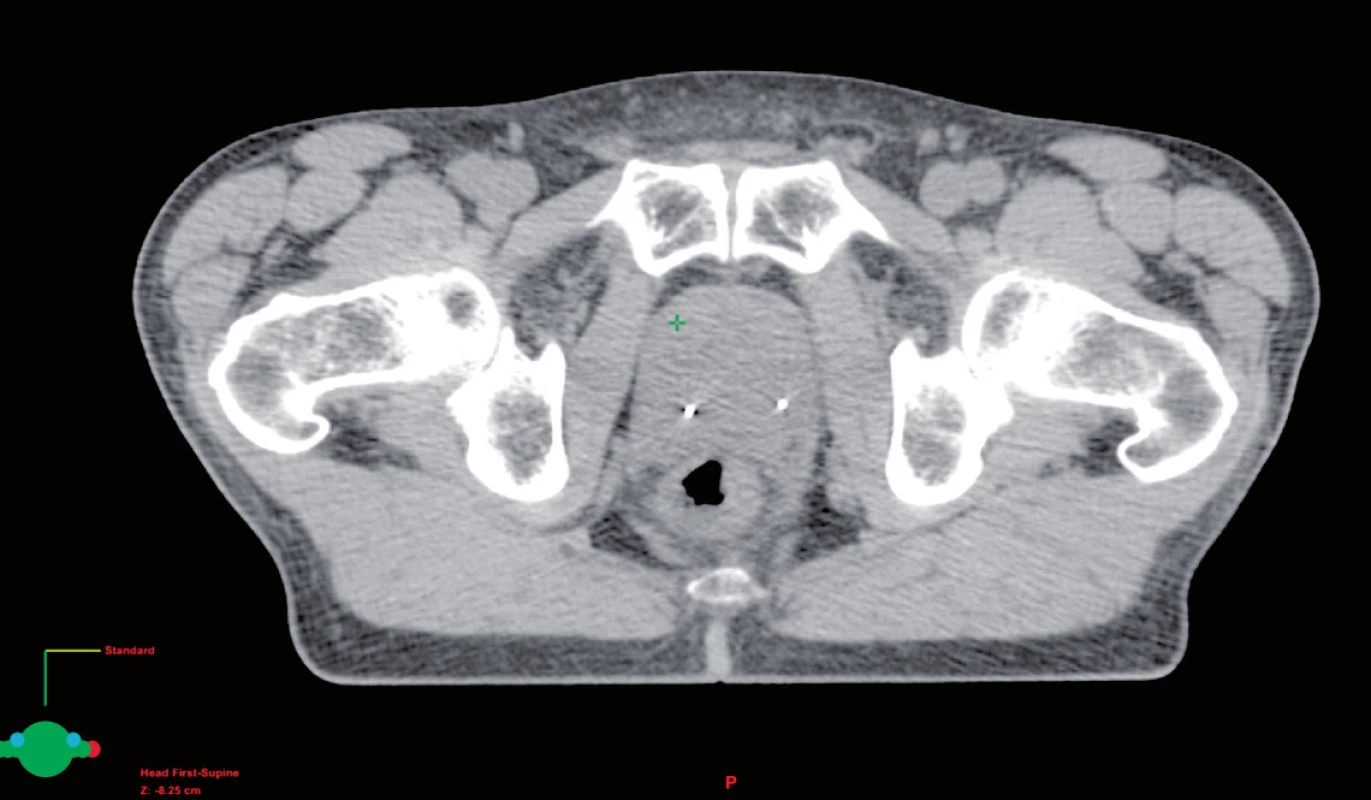 Zavedená lokalizační zlatá zrna v prostatě
Fig. 4. Localization of gold marker in the prostate

