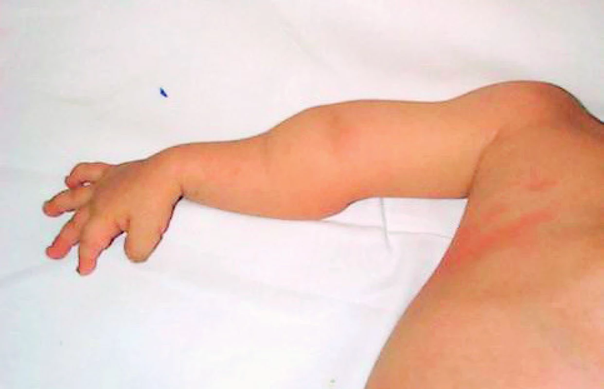 Deformity horní končetiny po opakovaných frakturách.
Fig. 6. Upper limb deformities after repeated fractures.