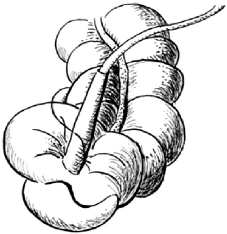 Schéma ACE operace
Fig. 1. ACE procedure – a scheme